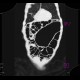 Volvulus of sigmoid colon: CT - Computed tomography