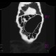 Volvulus of sigmoid colon: CT - Computed tomography