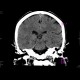 Early changes of brain ischemia, MCA: CT - Computed tomography