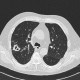 Wegener's granulomatosis: CT - Computed tomography