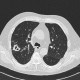 Wegener's granulomatosis: CT - Computed tomography