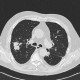 Wegener's granulomatosis: CT - Computed tomography