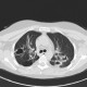 Wegener's granulomatosis, HRCT: CT - Computed tomography