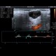 Pleomorphic adenoma of parotid gland: US - Ultrasound