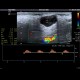 Pleomorphic adenoma of parotid gland: US - Ultrasound