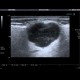 Pleomorphic adenoma of parotid gland: US - Ultrasound