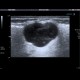 Pleomorphic adenoma of parotid gland: US - Ultrasound