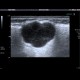 Pleomorphic adenoma of parotid gland: US - Ultrasound