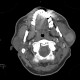 Warthin tumor, parotid gland: CT - Computed tomography