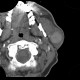 Warthin tumor, parotid gland: CT - Computed tomography