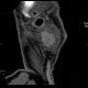 Warthin tumor, parotid gland: CT - Computed tomography