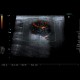 Warthin tumor, parotid gland: US - Ultrasound