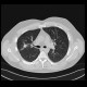 Wegener's granulomatosis, HRCT: CT - Computed tomography