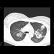 Wegener's granulomatosis: CT - Computed tomography