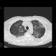 Wegener's vasculitis, sequel of pneumorhagia, alveolar bleeding: CT - Computed tomography