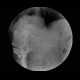Whipple procedure, hepatico-jejuno anastomosis, biliary ascites, leak of anastomosis: RF - Fluoroscopy