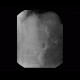 Whipple procedure, hepatico-jejuno anastomosis, biliary ascites, leak of anastomosis: RF - Fluoroscopy