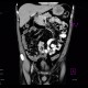 Wirsungolithiasis: CT - Computed tomography