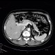 Wirsungolithiasis: CT - Computed tomography