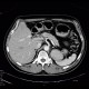 Wirsungolithiasis: CT - Computed tomography