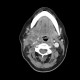 Inflammatory lymph node with liquefaction: CT - Computed tomography