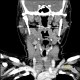 Inflammatory lymph node with liquefaction: CT - Computed tomography