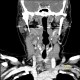 Inflammatory lymph node with liquefaction: CT - Computed tomography
