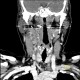 Inflammatory lymph node with liquefaction: CT - Computed tomography