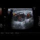 Inflammatory lymph node with liquefaction: US - Ultrasound