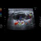 Inflammatory lymph node with liquefaction: US - Ultrasound