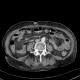 Edema of mesenteric fat in anasarca: CT - Computed tomography