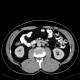 Duplication of inferior vena cava, VCI: CT - Computed tomography