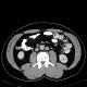 Duplication of inferior vena cava, VCI: CT - Computed tomography