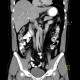 Duplication of inferior vena cava, VCI: CT - Computed tomography