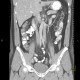Duplication of inferior vena cava, VCI: CT - Computed tomography