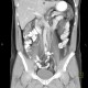 Duplication of inferior vena cava, VCI: CT - Computed tomography