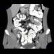 Colitis, ileitis, inflammation of terminal ileum and large bowel: CT - Computed tomography