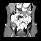 Colitis, ileitis, inflammation of terminal ileum and large bowel: CT - Computed tomography