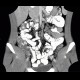 Colitis, ileitis, inflammation of terminal ileum and large bowel: CT - Computed tomography