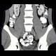 Colitis, ileitis, inflammation of terminal ileum and large bowel: CT - Computed tomography