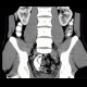 Colitis, ileitis, inflammation of terminal ileum and large bowel: CT - Computed tomography