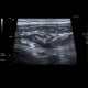 Colitis, ileitis, inflammation of terminal ileum and large bowel: US - Ultrasound