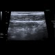 Colitis, ileitis, inflammation of terminal ileum and large bowel: US - Ultrasound