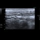 Colitis, ileitis, inflammation of terminal ileum and large bowel: US - Ultrasound