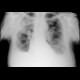 Pneumonia, pleural effusion: X-ray - Plain radiograph