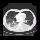 Hypostatic pneumonia, pleural effusion: CT - Computed tomography