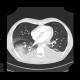 Hypostatic pneumonia, pleural effusion: CT - Computed tomography