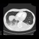 Hypostatic pneumonia, pleural effusion: CT - Computed tomography