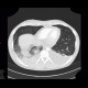 Hypostatic pneumonia, pleural effusion: CT - Computed tomography