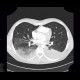 Hypostatic pneumonia, pleural effusion: CT - Computed tomography